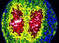 gamma camera image of athsmatic lungs