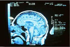 X-ray picture of human brain
