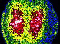 Scintigram - a gamma ray image of some lungs after inhaling radioactive gas. Not kidneys. Sorry Kim.